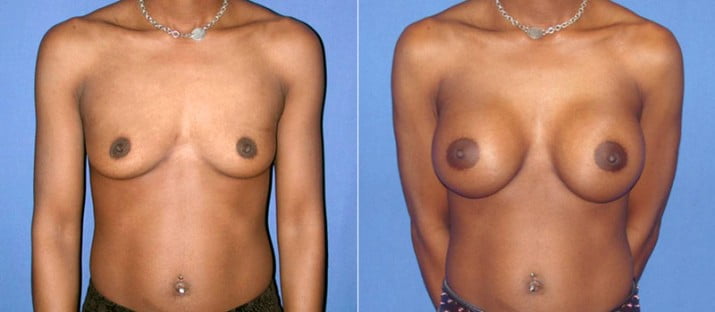 Breast Augmentation 11