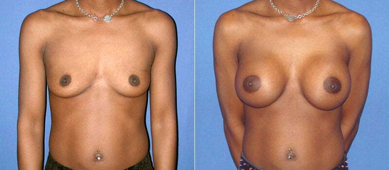 Breast Augmentation 11