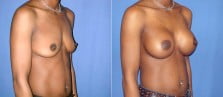 breast-augmentation-21b