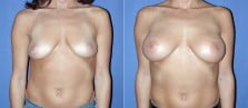 breast-augmentation-27a