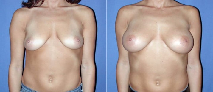 Breast Augmentation 12
