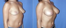 breast-augmentation-27b