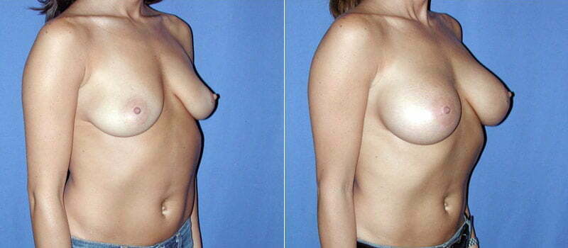 Breast Augmentation 12