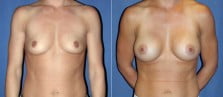 breast-augmentation-31a