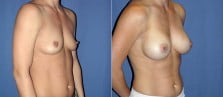 breast-augmentation-31b-left