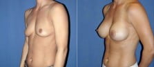breast-augmentation-31b-right