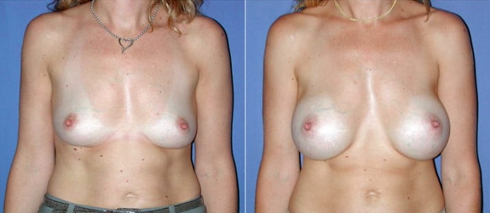 Breast Augmentation 14