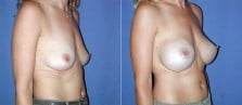 breast-augmentation-32b