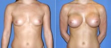 breast-augmentation-35a