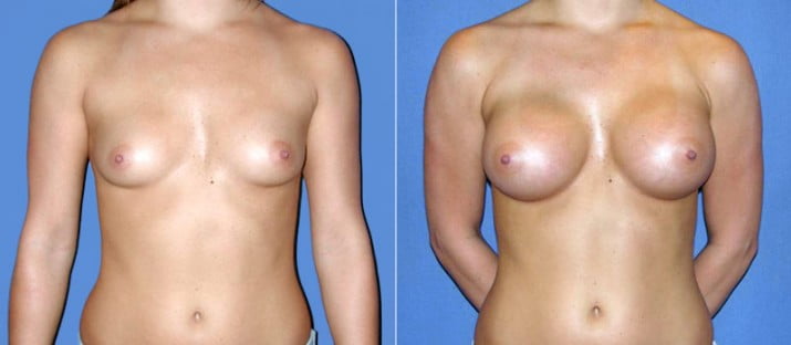 Breast Augmentation 15