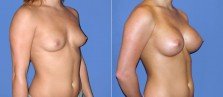 breast-augmentation-35b