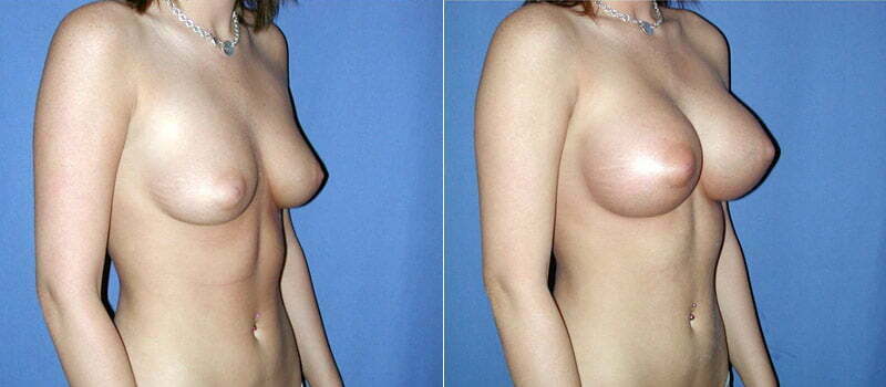 Breast Augmentation 16
