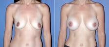 breast-augmentation-43a