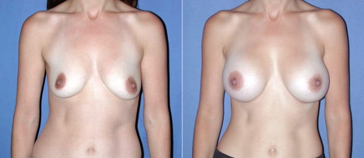 Breast Augmentation 17