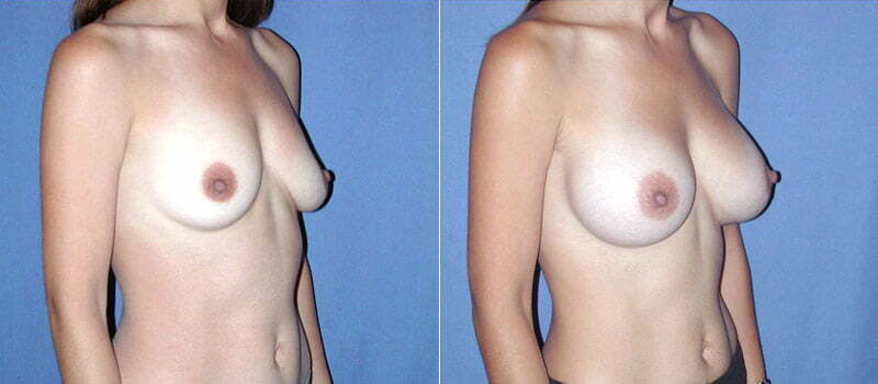 Breast Augmentation 17