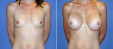 breast-augmentation-45a