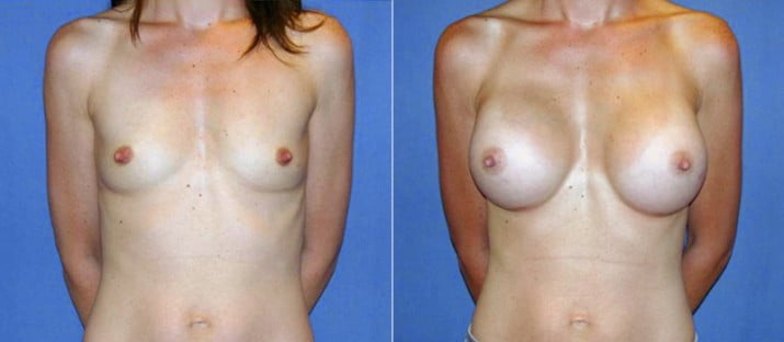 Breast Augmentation 18