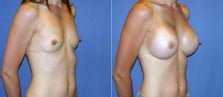 breast-augmentation-45b