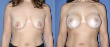 Breast Lift with Implants 1