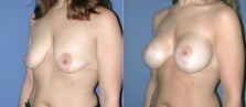 breast-lift-with implants-01b