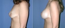 breast-lift-with-implants-01c