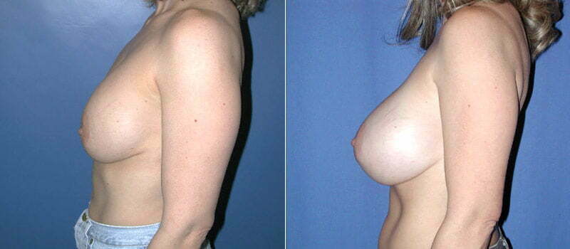 Breast Revision 1