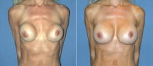 Breast Revision 2
