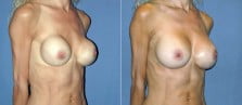 breast-revision-3b-capsulectomy-exchange