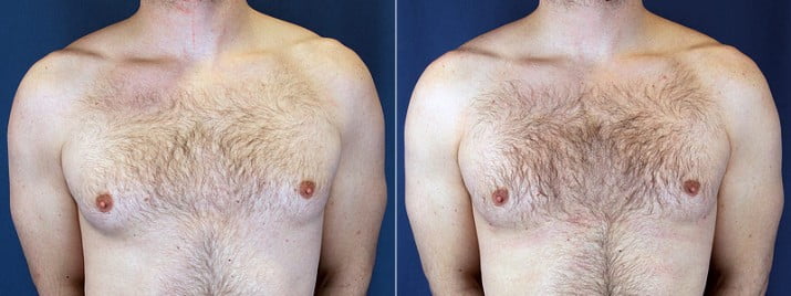 Male Breast Reduction 1