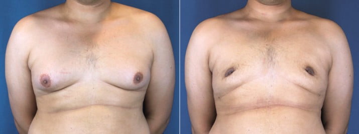 Male Breast Reduction 2