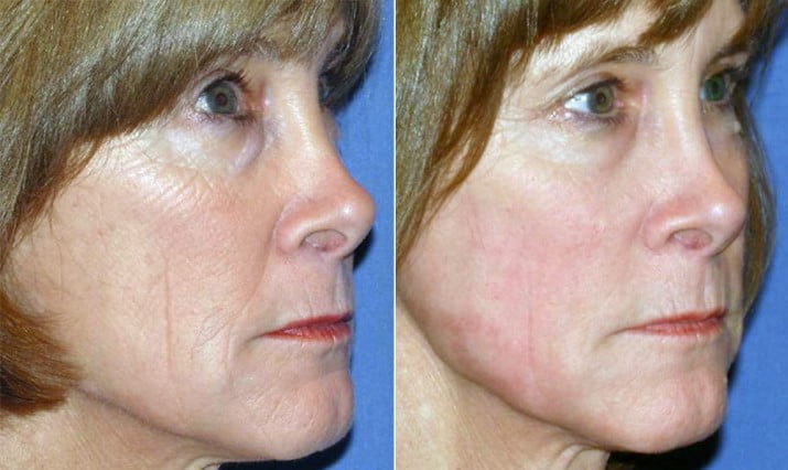 Laser Skin Resurfacing Patient 2