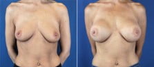 breast-augmentation-2991a