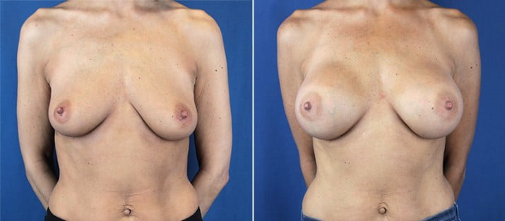 Breast Augmentation 19