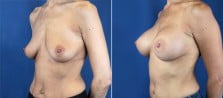 breast-augmentation-2991b