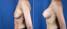 breast-augmentation-2991c