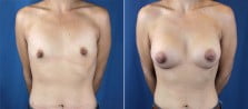 breast-augmentation-3017a