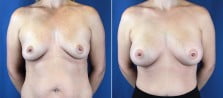 breast-augmentation-3028a