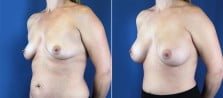 breast-augmentation-3028b