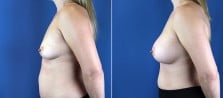 breast-augmentation-3028c
