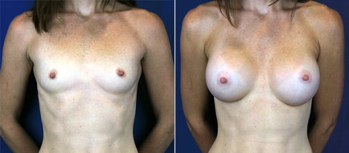 Breast Augmentation 23
