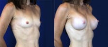 breast-augmentation-3055b
