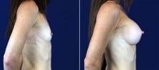 breast-augmentation-3055c