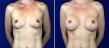 breast-augmentation-3077a