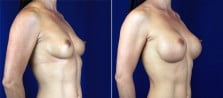 breast-augmentation-3077b