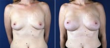 breast-augmentation-3093a