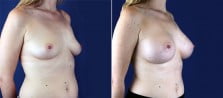 breast-augmentation-3093b