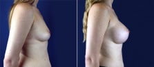 breast-augmentation-3093c
