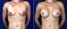 breast-augmentation-3104a