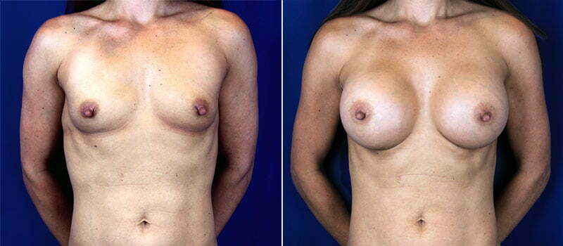 Breast Augmentation 25