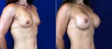 breast-augmentation-3104b